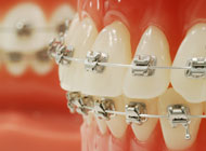 表側ブラケット矯正