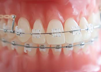 矯正治療中も審美性を損なわない