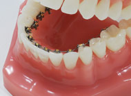 舌側ブラケット矯正