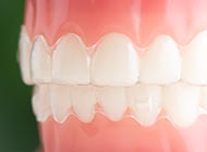 マウスピース型矯正装置