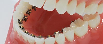歯の裏側に取り付ける目立たない矯正も
