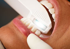 口腔内スキャン