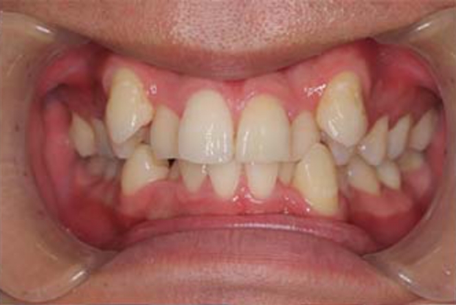 Before