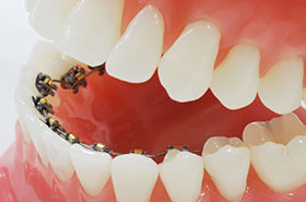 裏側ブラケット矯正