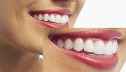 目立たないマウスピース矯正